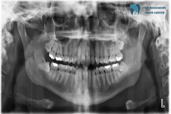 Compare intraoral radiography and extraoral radiography: Which one is better? Learn about the advantages and disadvantages of each and choose the right method for you.