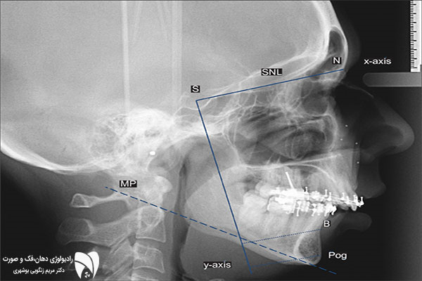 لترال سفالومتری ارتودنسی ابزاری کلیدی برای بهبود نتایج ارتودنسی است. در این مطلب، کاربردها و مزایای تصویربرداری ارتودنسی بررسی شده‌اند.