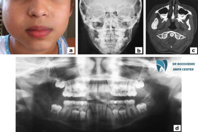 Child jaw imaging is essential for child jaw diagnosis and identifying child jaw problems. It helps in early detection and proper treatment.