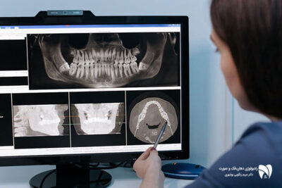 اشعه رادیولوژی دهان آیا واقعاً خطرناک است؟ در این مقاله، تأثیر رادیولوژی دندانپزشکی بر سلامت و ضررهای تصویربرداری دندان را بررسی میکنیم.