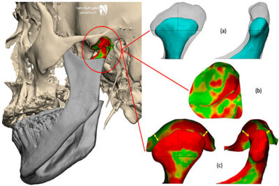 تحلیل مفصل فکی با تصویربرداری سهبعدی فک روشی دقیق برای تشخیص مشکلات مفصل گیجگاهی فکی است. با این روش مشکلات فک را سریعتر شناسایی کنید.