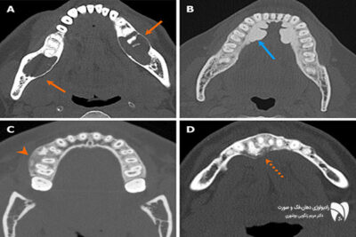 تصویربرداری پزشکی فک نقش مهمی در تشخیص سرطان فک دارد و با کمک رادیولوژی سرطان صورت امکان تشخیص دقیق و زودهنگام فراهم است.