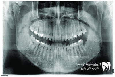 رادیوگرافی پانورامیک دندان ابزاری کلیدی برای تشخیص مشکلات دندانی است. در این مقاله به کاربردها و مزایای رادیوگرافی پانورامیک می‌پردازیم.