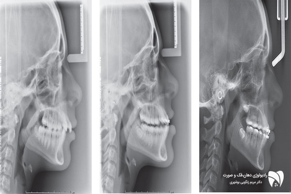 لترال سفالومتری ابزار کلیدی در تصویربرداری ارتودنسی است. با بررسی 5 مزیت، تاثیر آن در تشخیص و درمانهای دقیق را بیابید.
