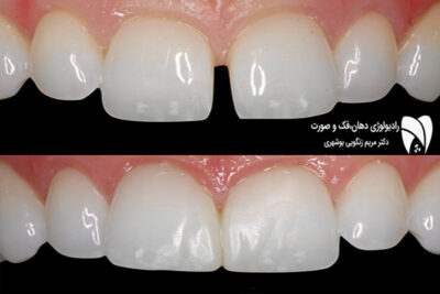 باندینگ کامپوزیت یک روش ترمیمی پیشرفته برای دندان‌هاست که مزایا و معایب مختلفی دارد. در این مطلب به همه سوالات شما پاسخ داده‌ایم.