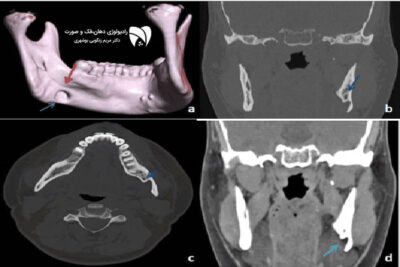 تحلیل حرکت فک با تصویربرداری سهبعدی فک، روشی دقیق برای درمان ناهنجاری فک است که دقت بالایی دارد و به بهبود روشهای درمانی کمک میکند.