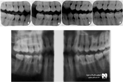 با رادیوگرافی بایت وینگ به تشخیص بیماری‌ های لثه بپردازید و از 3 مزیت مهم آن برای بررسی دقیق بیماری های لثه‌ها بهره‌مند شوید.