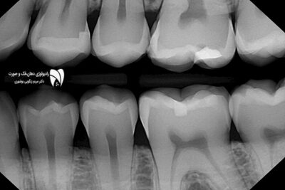 رادیوگرافی بایت‌ وینگ ابزاری کلیدی برای تشخیص پوسیدگی دندان است. در این مقاله با کاربردهای آن آشنا شوید. ضمنا به سوالات مهم در این مورد هم پاسخ دادیم.