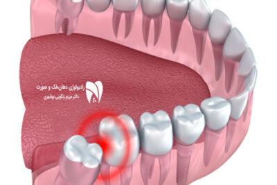 در این مقاله به بررسی علل خراب شدن دندان عقل، روش‌های درمان و پیشگیری از عفونت و همچنین مراقبت‌های پس از جراحی دندان های عقل پرداخته شده است.